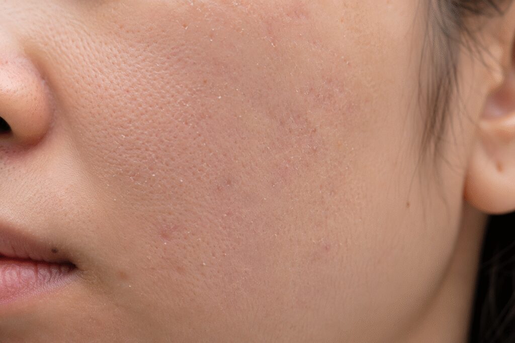 Why Do I Keep Getting Acne in the Same Spot? Here's What Your Skin Might Be Trying to Tell You 4 Close-up of facial skin showing dead skin cell buildup