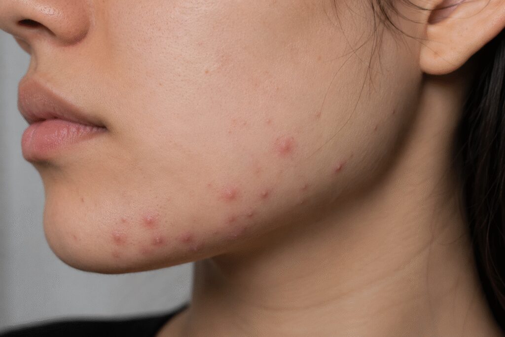 Why Do I Keep Getting Acne in the Same Spot? Here's What Your Skin Might Be Trying to Tell You 10 Close up photo of acne on jawline