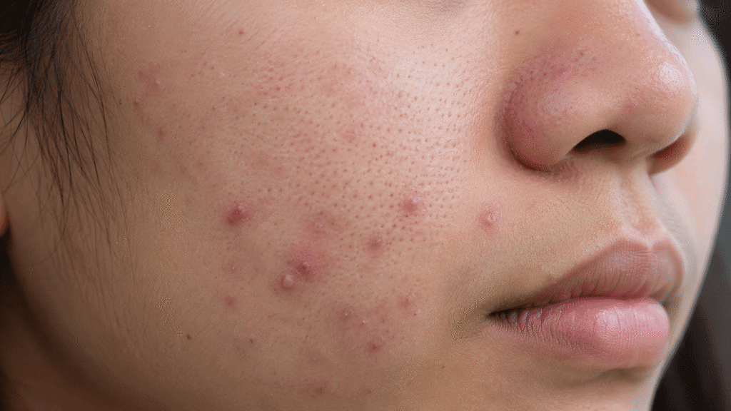 What Does Dipping Your Face in Ice Water Do? 3 Close up photo of an acne breakout