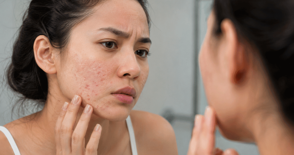 Can Dry Skin Make You Break Out