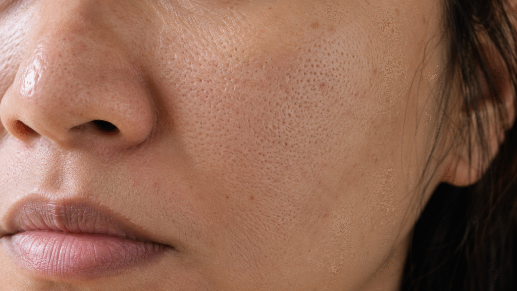 What Does Dipping Your Face in Ice Water Do? 2 Close-up of enlarged facial pores.