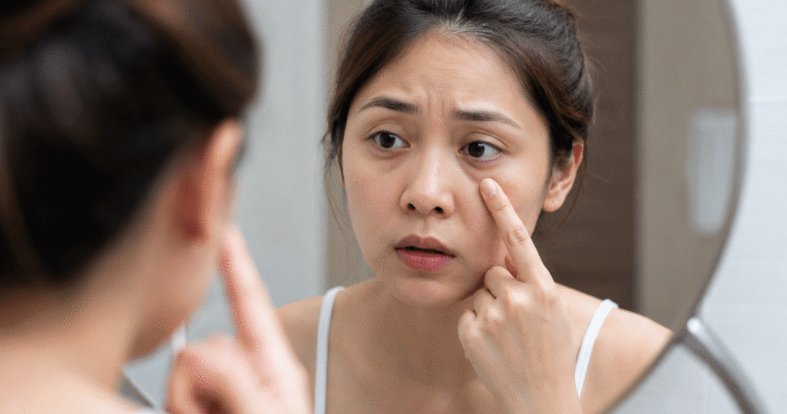 Types of eye bags