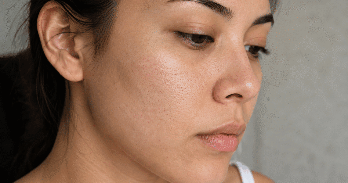 How to reduce pores on face