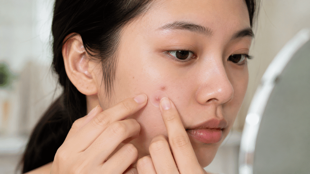 What to do after removing pimple patch