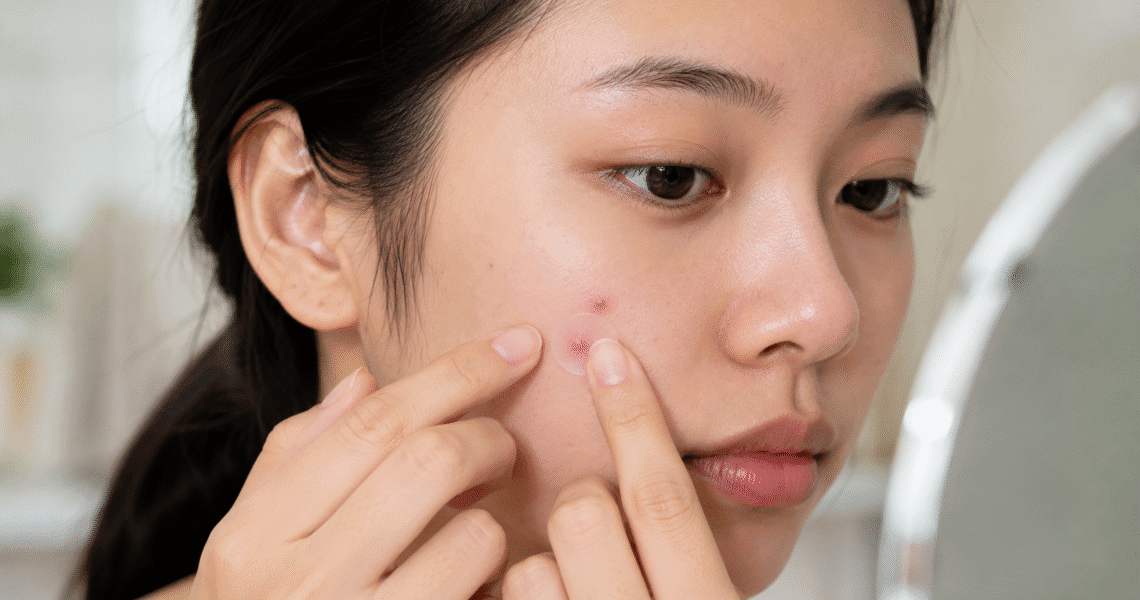 What to do after removing pimple patch