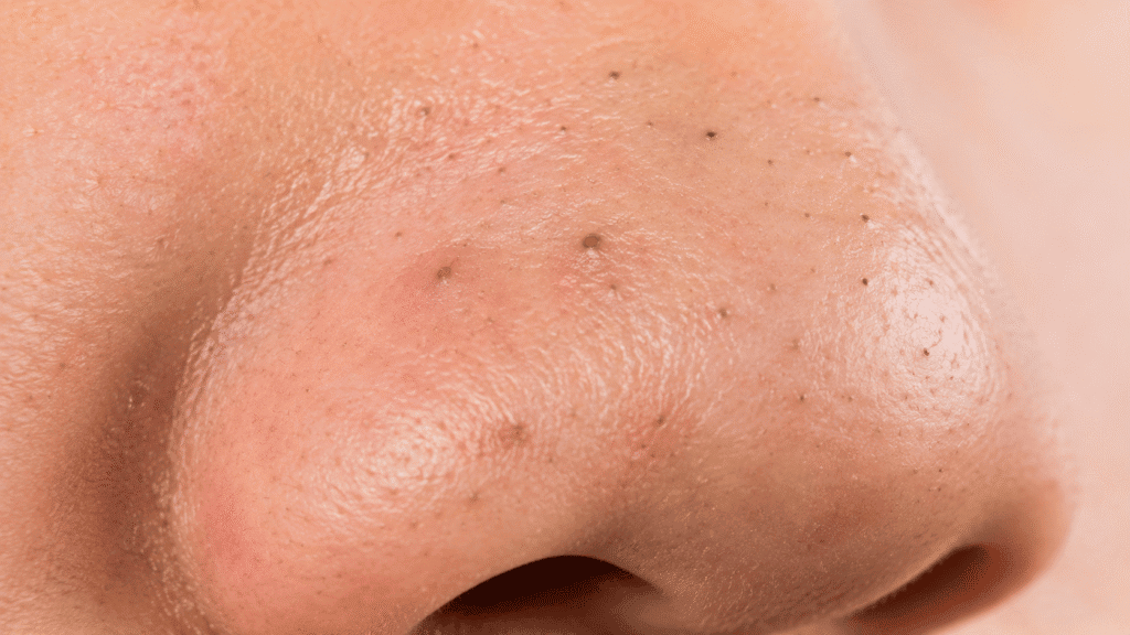 Close-up of blackheads on the nose.