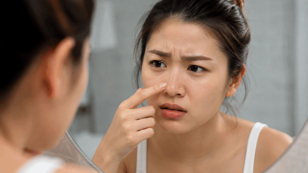 Sebaceous Filament vs Blackhead