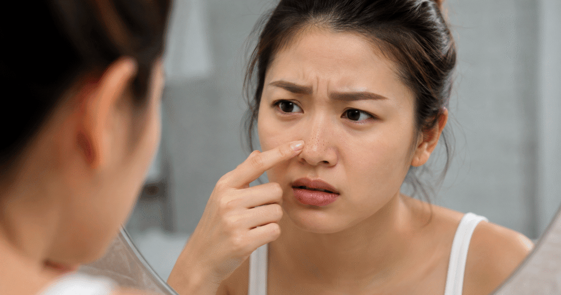Sebaceous Filament vs Blackhead